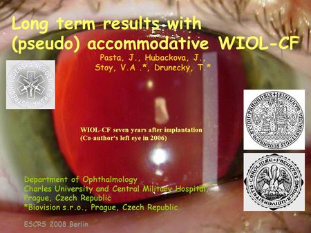 Long term results with (pseudo) accommodative WIOL-CF