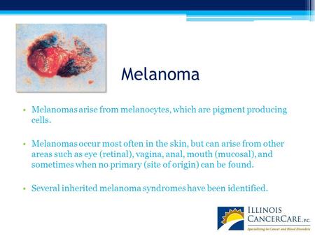 Melanoma Melanomas arise from melanocytes, which are pigment producing cells. Melanomas occur most often in the skin, but can arise from other areas such.