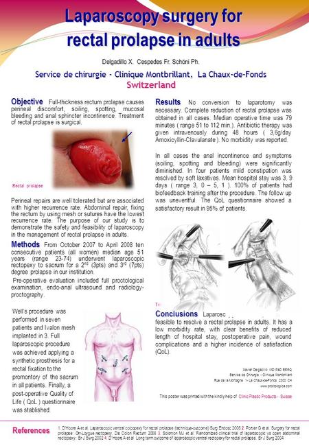 Objective Objective Full-thickness rectum prolapse causes perineal discomfort, soiling, spotting, mucosal bleeding and anal sphincter incontinence. Treatment.