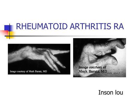 RHEUMATOID ARTHRITIS RA Inson lou. Epidemiology Symptoms signs Labs Diagnosis Treatment.