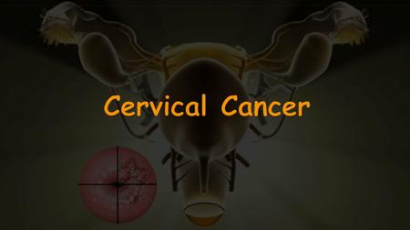 Cervical Cancer.