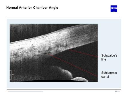 Normal Anterior Chamber Angle