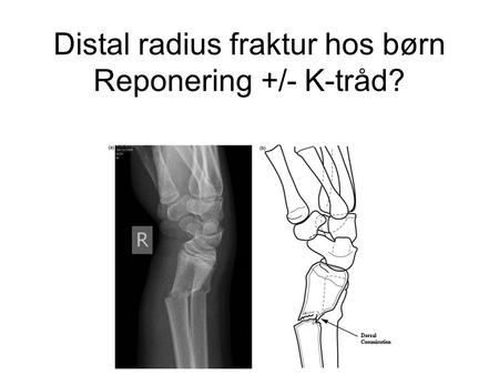 Distal radius fraktur hos børn Reponering +/- K-tråd?