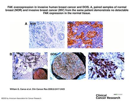 FAK overexpression in invasive human breast cancer and DCIS