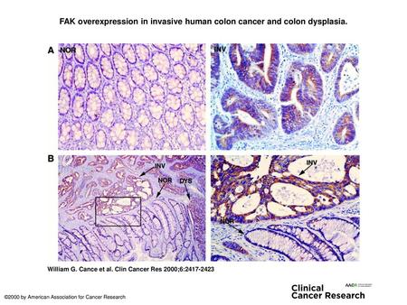 FAK overexpression in invasive human colon cancer and colon dysplasia.