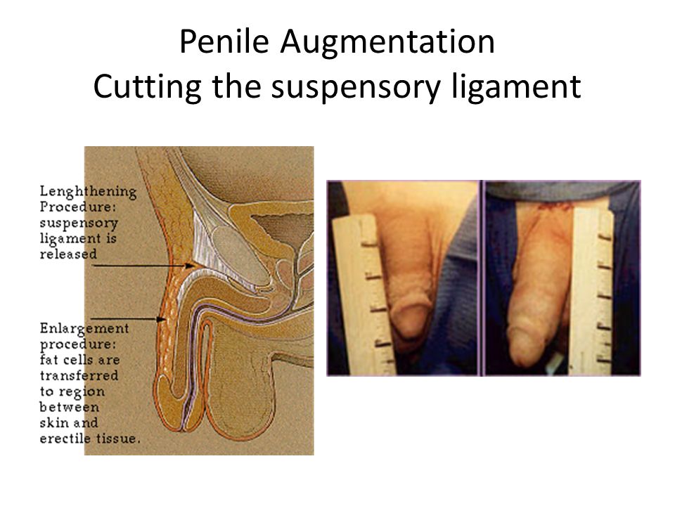 Penis Ligament Surgery 17
