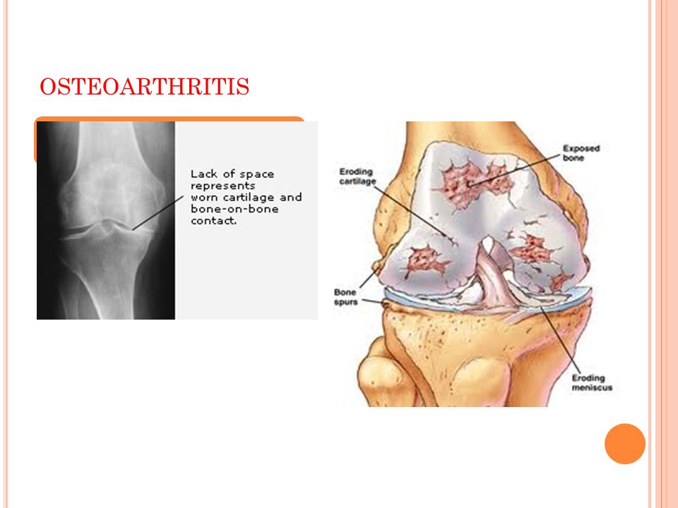 Synapsis of osteoarthritis muscle atrophy and
