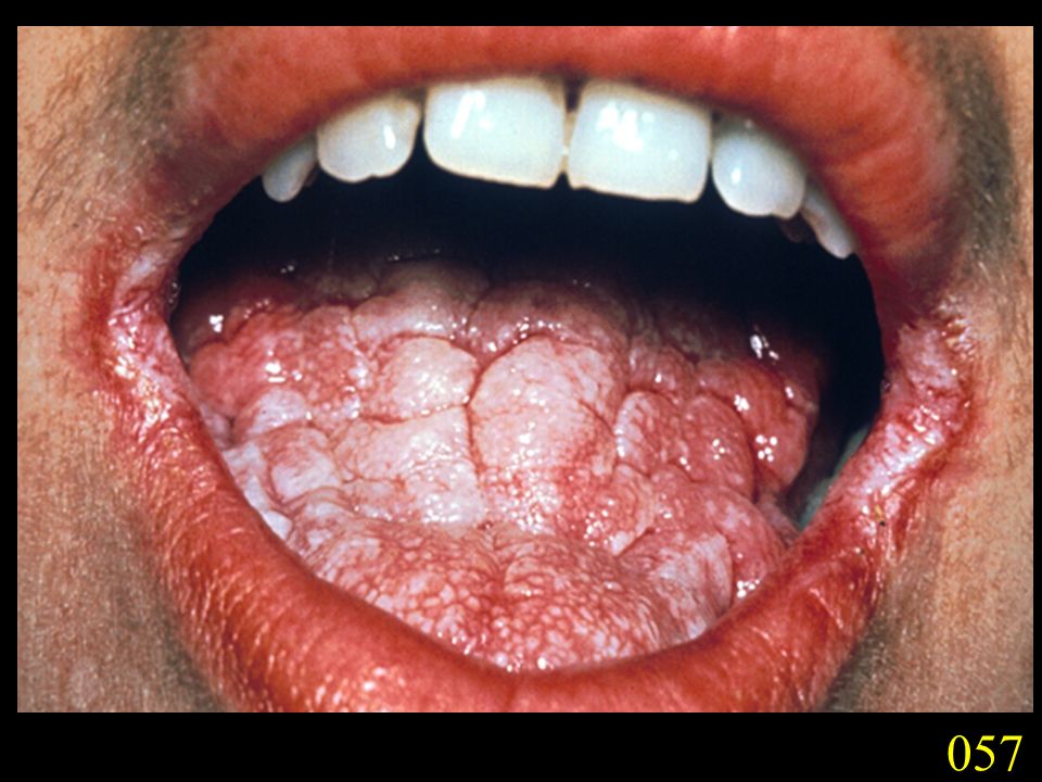 Candidiasis In The Mouth 79