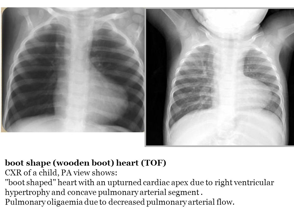 various chest disease their xr findings appearance ppt video boot shaped heart