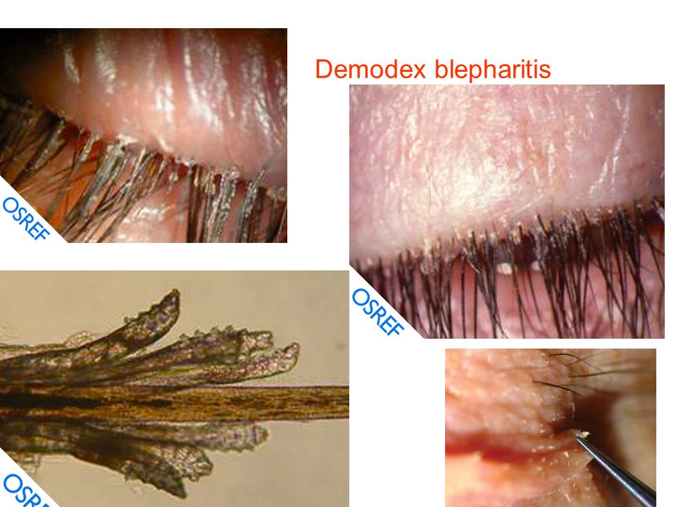 Demodex Folliculorum Closeup Demodicosis Called Demodectic ...