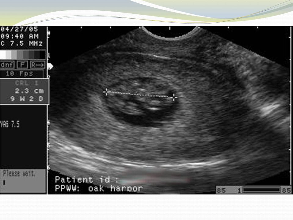 are ultrasound dating scans accurate