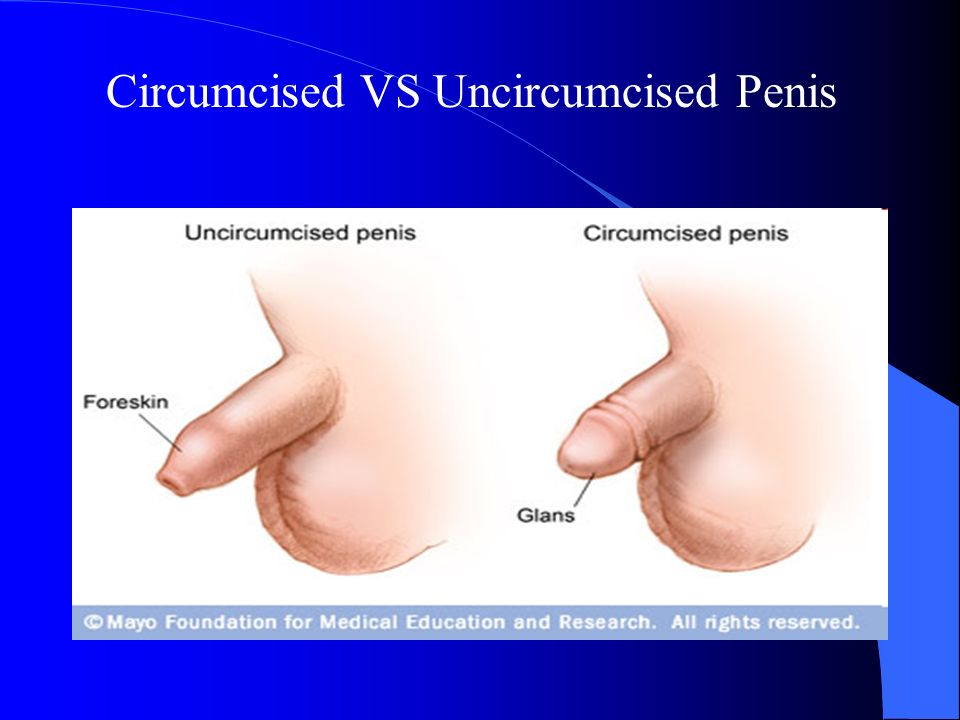 Uncircumcised Vs Circumcised Penis 86