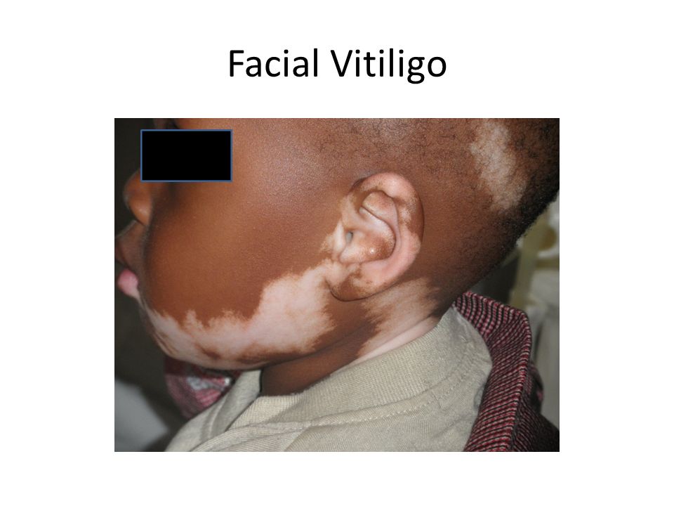 Facial Vitiligo 74
