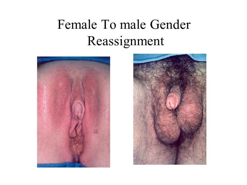 Female To Male Sex Reassignment Surgery Pictures 74