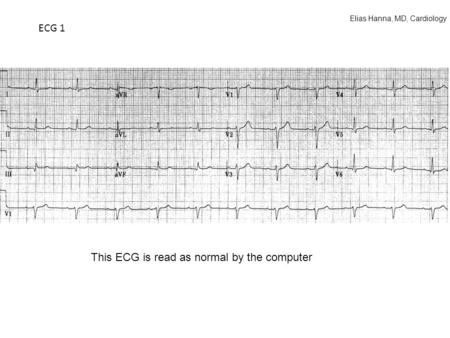 ECG 1 This ECG is read as normal by the computer Elias Hanna, MD, Cardiology.