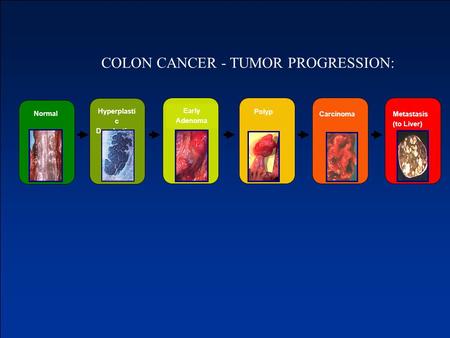Early Adenoma Normal Hyperplasti c Dysplastic Carcinoma Polyp Metastasis (to Liver) COLON CANCER - TUMOR PROGRESSION: Tumor progression.