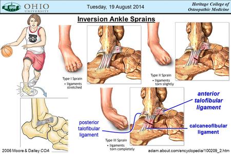 Inversion Ankle Sprains