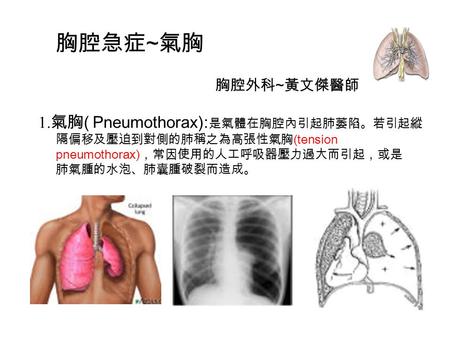 胸腔急症~氣胸 1.氣胸( Pneumothorax):是氣體在胸腔內引起肺萎陷。若引起縱 胸腔外科~黃文傑醫師