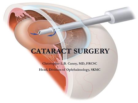 CATARACT SURGERY Christopher L.B. Canny, MD, FRCSC