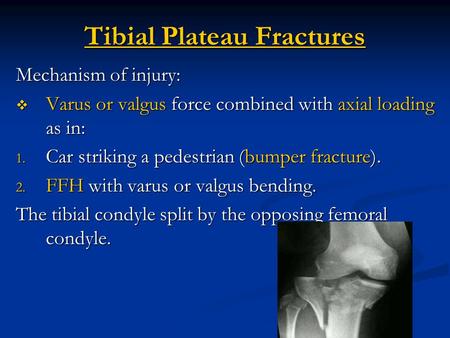 Tibial Plateau Fractures