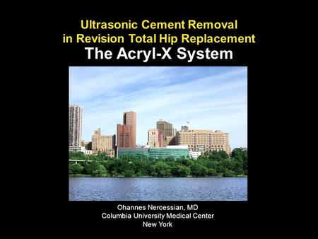 Ultrasonic Cement Removal in Revision Total Hip Replacement The Acryl-X System Ohannes Nercessian, MD Columbia University Medical Center New York.