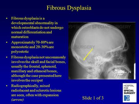 Fibrous Dysplasia Fibrous dysplasia is a developmental abnormality in which osteoblasts do not undergo normal differentiation and maturation Approximately.