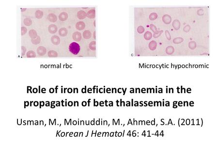 Role of iron deficiency anemia in the propagation of beta thalassemia gene Usman, M., Moinuddin, M., Ahmed, S.A. (2011) Korean J Hematol 46: 41-44 Microcytic.
