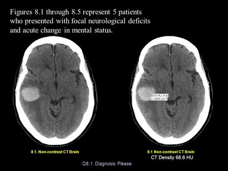 Figures 8.1 through 8.5 represent 5 patients who presented with focal neurological deficits and acute change in mental status. 8.1. Non-contrast CT Brain.