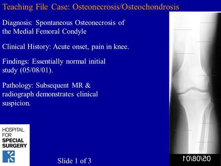 Teaching File Case: Osteonecrosis/Osteochondrosis Diagnosis: Spontaneous Osteonecrosis of the Medial Femoral Condyle Findings: Essentially normal initial.