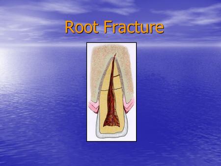 Root Fracture Various radiographic views help to demonstrate the extent of the fracture or fractures. The location of the root fracture determines the.