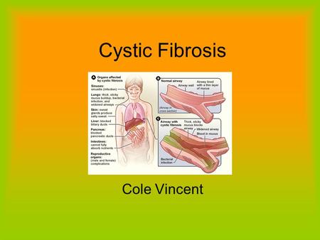 Cystic Fibrosis Cole Vincent. Symptoms Digestive Symptoms – intestinal blockage, poor weight gain and height growth Respiratory Symptoms – coughing, wheezing,