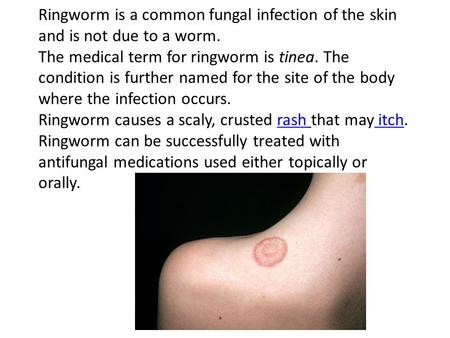 Ringworm is a common fungal infection of the skin and is not due to a worm. The medical term for ringworm is tinea. The condition is further named for.