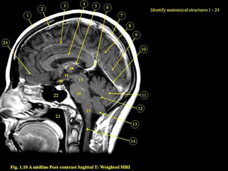 Fig A midline Post-contrast Sagittal T1 Weighted MRI