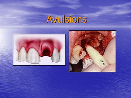 Avulsions If an immature permanent tooth has been out of the mouth for less than one hour and has an apical diameter greater than 1mm, pulpal revascularization.