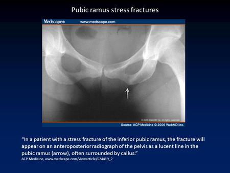 “In a patient with a stress fracture of the inferior pubic ramus, the fracture will appear on an anteroposterior radiograph of the pelvis as a lucent line.