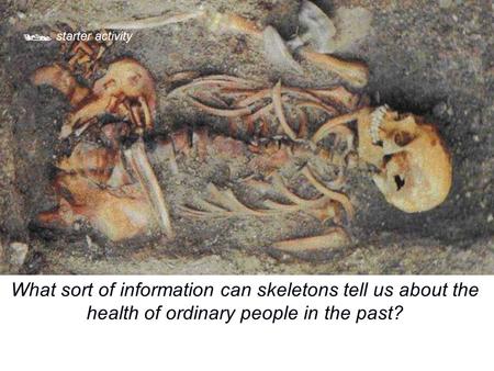 starter activity What sort of information can skeletons tell us about the health of ordinary people in the past?