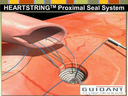 HEARTSTRINGTM Proximal Seal System