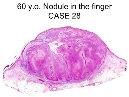 60 y.o. Nodule in the finger CASE 28. Case History Oct 2004 Excision with split-skin grafting Histology moderately differentiated squamous cell.