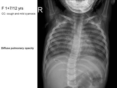 F 1+7/12 yrs CC: cough and mild cyanosis Diffuse pulmonary opacity.