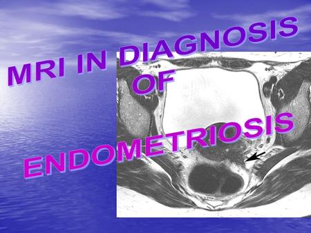 INTRODUCTION ENDOMETRIOSIS is a benign disorder characterised by proliferation of endometrial tissues outside the endometrial cavity. ENDOMETRIOSIS is.