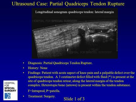 Ultrasound Case: Partial Quadriceps Tendon Rupture Diagnosis: Partial Quadriceps Tendon Rupture. History: None Findings: Patient with acute aspect of knee.