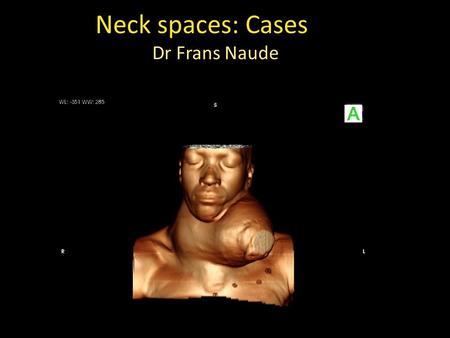 Neck spaces: Cases Dr Frans Naude. Lesotho patient presented with neck swelling for the last 26 years.