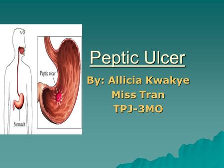 Peptic Ulcer By: Allicia Kwakye Miss Tran TPJ-3MO.