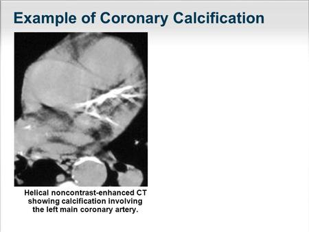 Helical noncontrast-enhanced CT showing calcification involving the left main coronary artery. Example of Coronary Calcification.