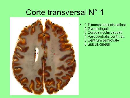 Corte transversal N° 1 1.Truncus corporis callosi 2.Gyrus cinguli 3.Corpus nuclei caudati 4.Pars centralis ventr.lat. 5.Centrum semiovale 6.Sulcus cinguli.