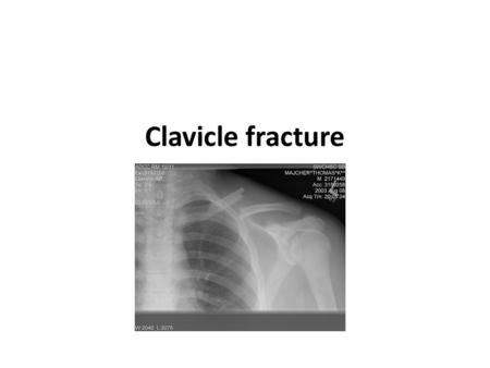 Clavicle fracture. Frequency Clavicle fractures involve approximately 5% of all fractures seen in hospital emergency admissions. Clavicles are the most.