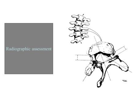 Radiographic assessment. –Valuable Dx tool –To help assist in etiology and Dx; curve magnitude; skeletal age; wedging; Rotation. –P - A view is better…for.
