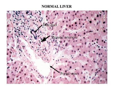 NORMAL LIVER Bile duct Hepatic arteriole Portal vein.