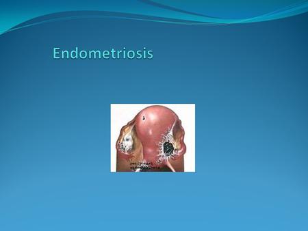 Endometriosis Presence of endometrial tissue (glands & stroma) outside the uterus which induces chronic inflammatory reaction Affects general physical,