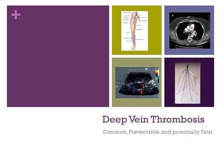 + Deep Vein Thrombosis Common, Preventable, and potentially Fatal.